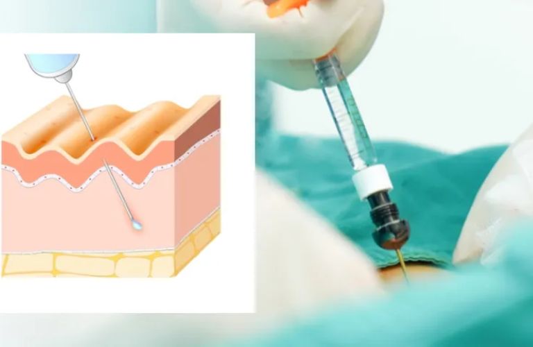 Tiêm Filler làm đầy vùng kín