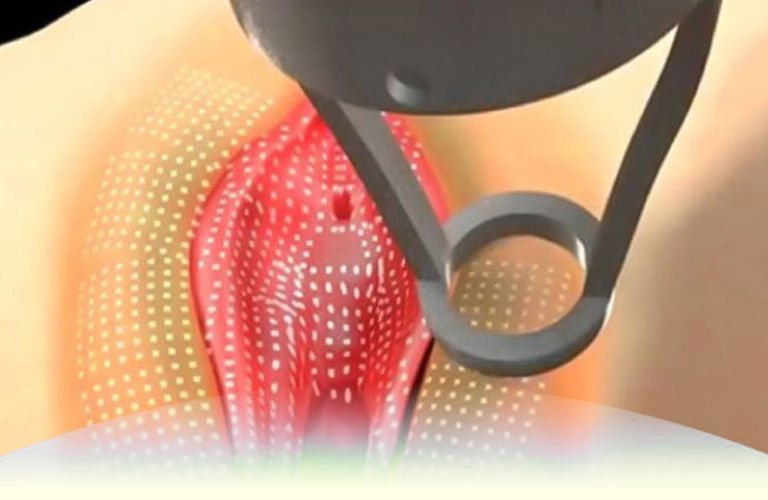 Trẻ hóa vùng kín bằng công nghệ Laser hoặc RF