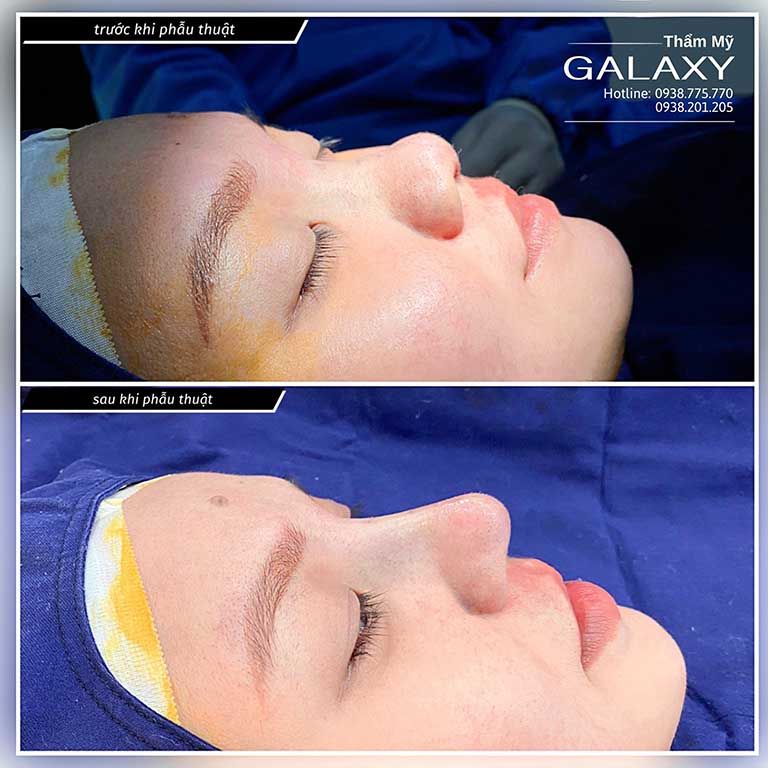 Trước và sau khi thẩm mỹ mũi tại Galaxy