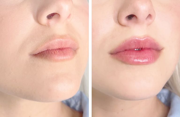Chi phí tiêm filler phụ thuộc vào nhiều yếu tố