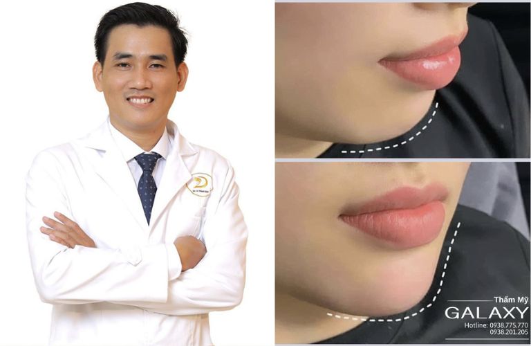Tiêm filler an toàn, hiệu quả tại Thẩm mỹ viện Galaxy 